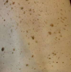 Seborrheic Keratosis Removal Colchester & Chelmsford