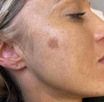 Time to get rid of those pesky pigmentation spots Colchester & Chelmsford