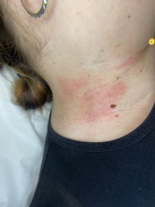 How do you remove a skin tag?