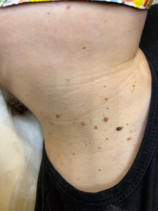 Skin Tags on the neck Colchester & Chelmsford