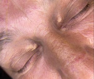 What is Xanthelasma? Colchester & Chelmsford
