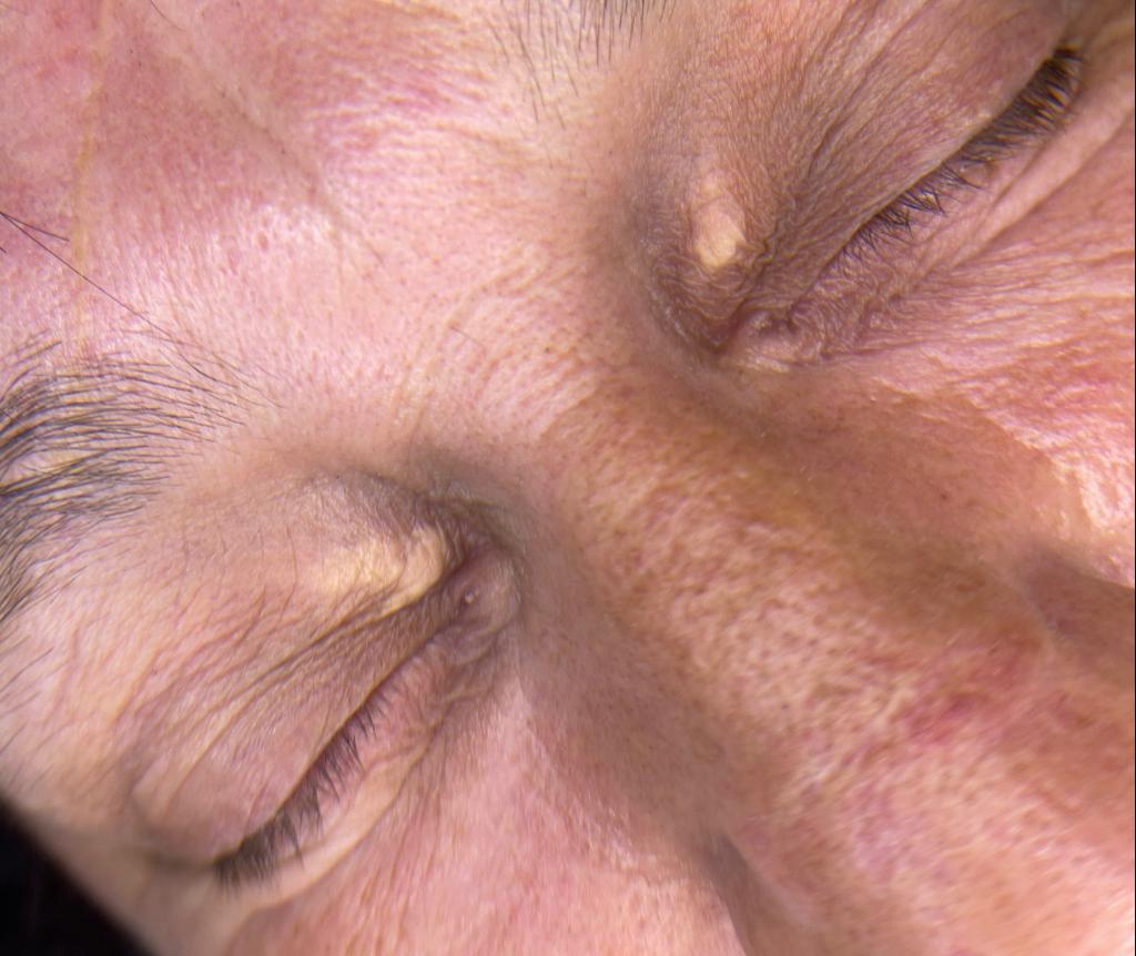 What is Xanthelasma? Colchester & Chelmsford