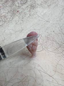 Can I remove Skin Tags myself? Colchester & Chelmsford