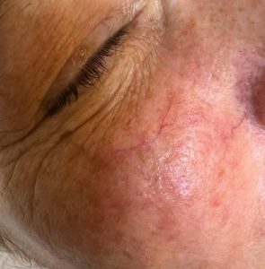 Thread Veins Colchester & Chelmsford