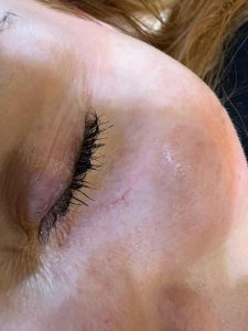 Thread Vein Removal Colchester & Chelmsford