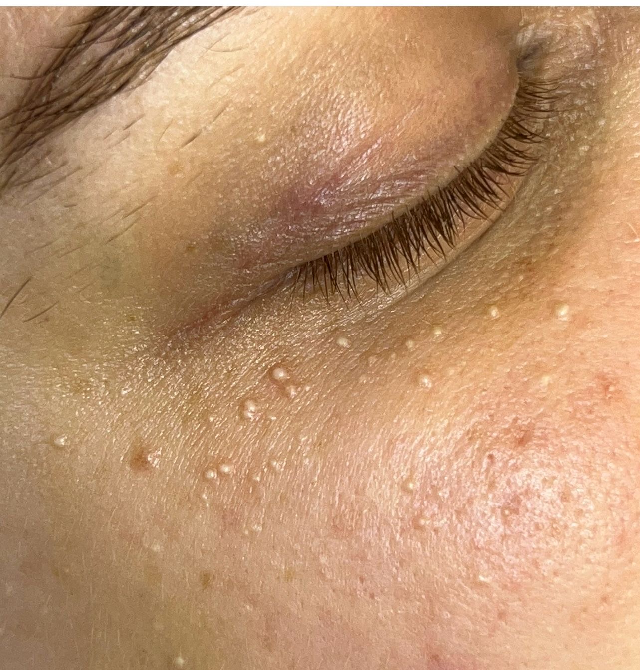 Milia Removal Colchester & Chelmsford
