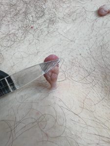 Skin Tag Removal Colchester & Chelmsford