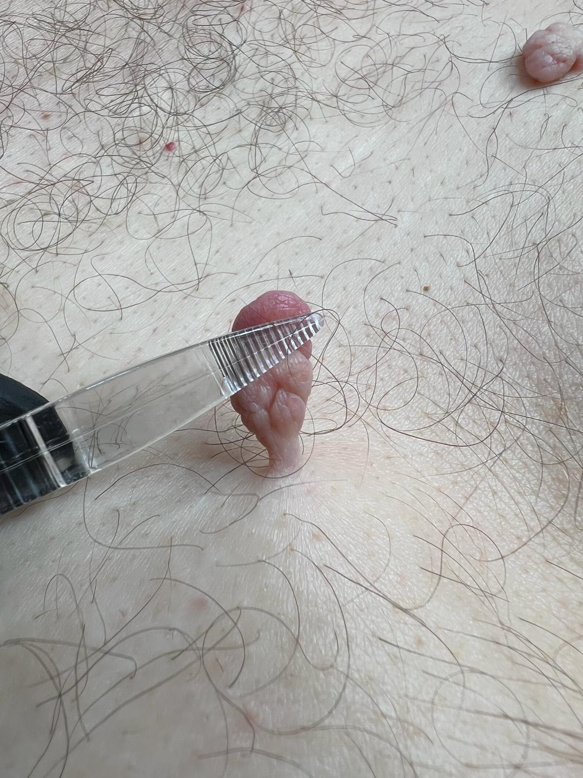 Skin Tag Removal Colchester & Chelmsford