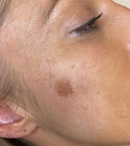 Pigmentation Spot Removal Colchester & Chelmsford