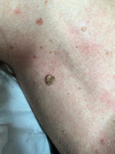 Wart Removal Colchester & Chelmsford 