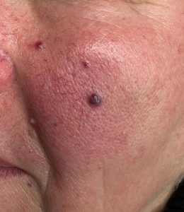 Blood Spot Removal Colchester & Chelmsford 