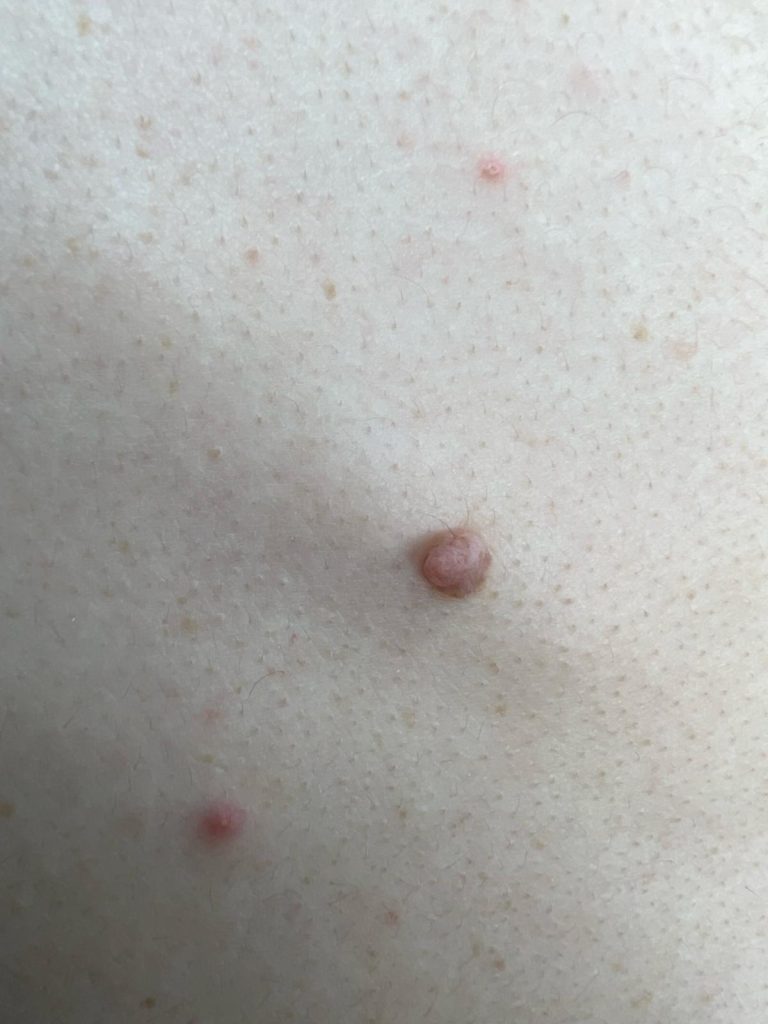 Mole Removal Colchester