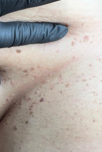 Seborrheic Keratosis Removal Colchester & Chelmsford