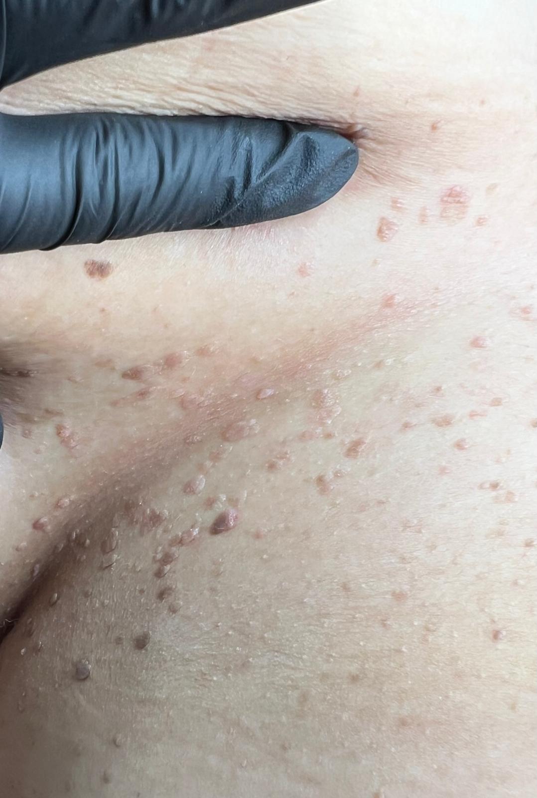 Seborrheic Keratosis Removal Colchester & Chelmsford
