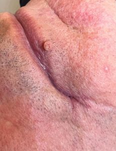 Filiform Wart Removal Colchester & Chelmsford