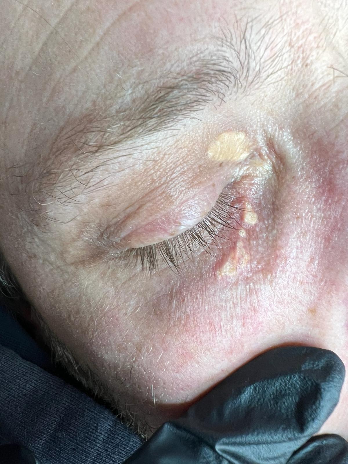 Xanthelasma Removal Colchester & Chelmsford