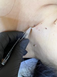 skin tag removal Colchester & Chelmsford
