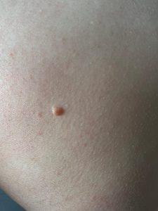 Mole Removal Colchester & Chelmsford