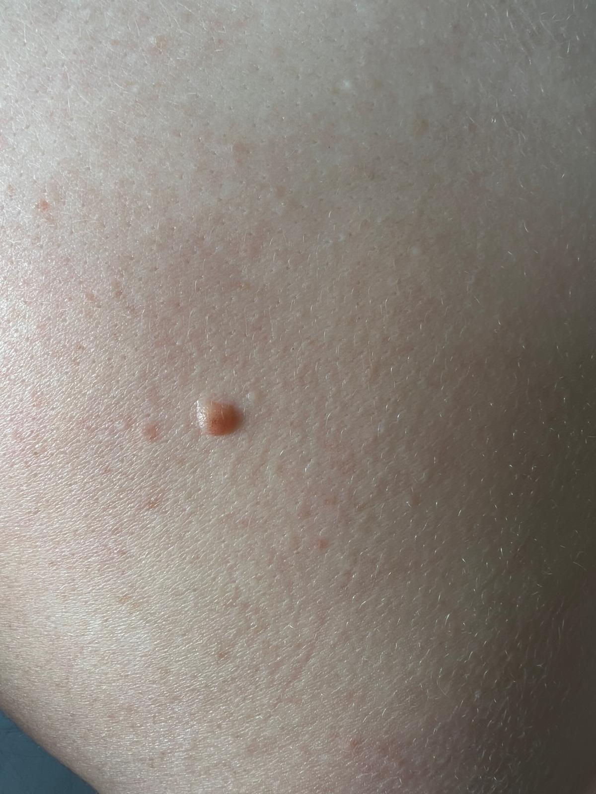 Mole Removal Colchester & Chelmsford