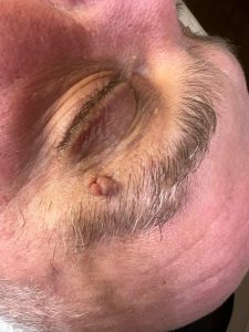 Skin Tag Removal Colchester & Chelmsford