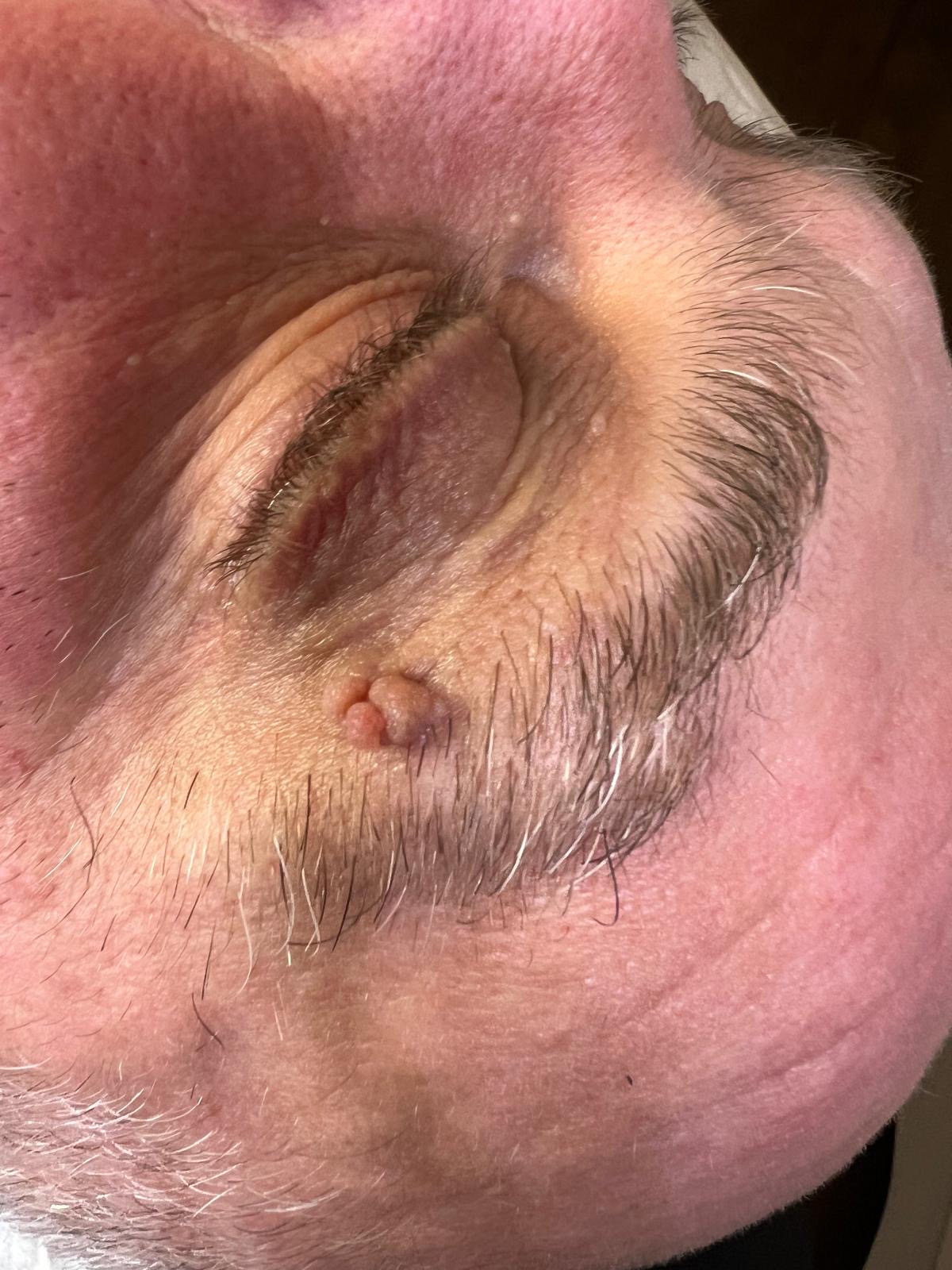 Skin Tag Removal Colchester & Chelmsford