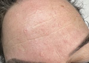 Sebaceous Hyperplasia Colchester & Chelmsford