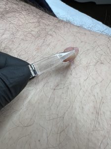 Skin Tag Removal Colchester & Chelmsford