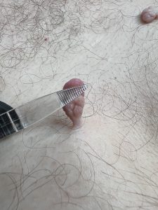 Skin Tag Removal Colchester & Chelmsford