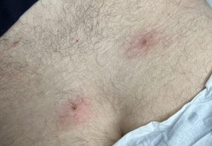Skin Tag Removal Colchester & Chelmsford