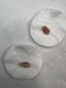 Skin Tag Removal Colchester & Chelmsford