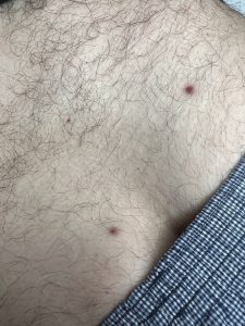 Skin Tag Removal Colchester & Chelmsford