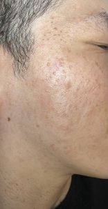Dermatosis Papulosa Nigra
