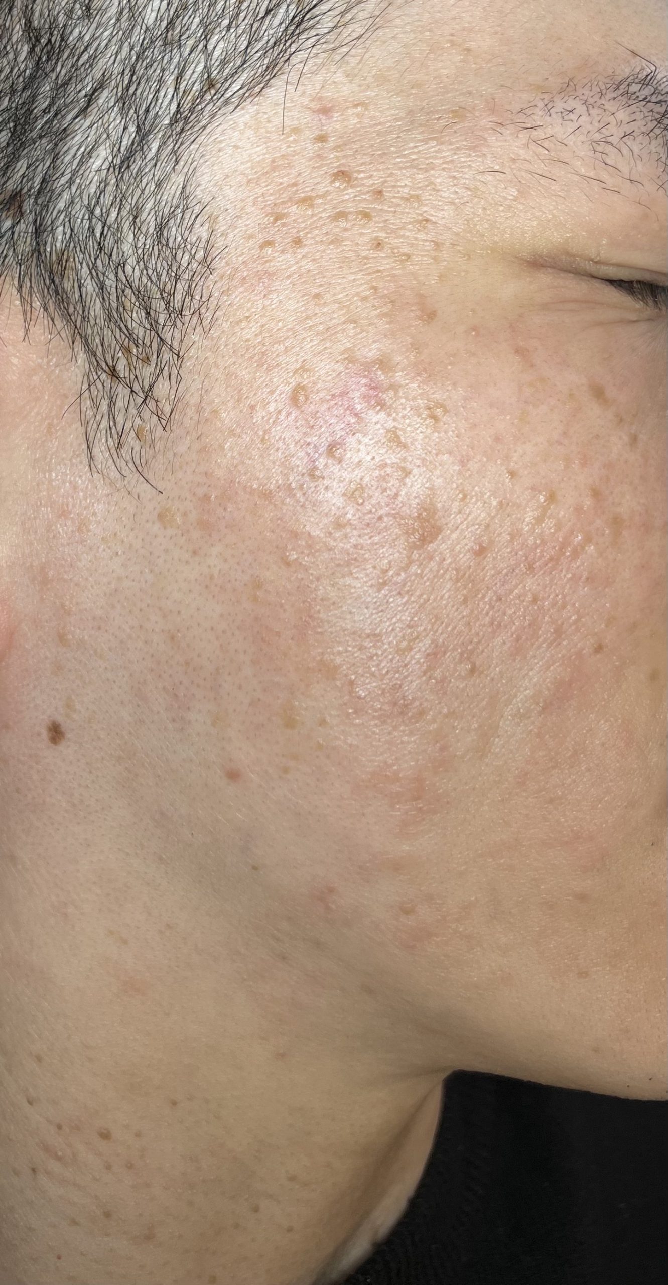Dermatosis Papulosa Nigra