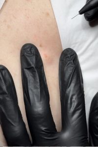 Cyst Removal Colchester & Chelmsford