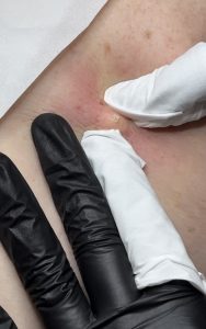 Cyst Removal Colchester & Chelmsford