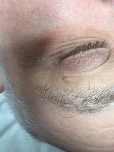 Skin Tag Removal Colchester & Chelmsford 