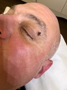 Skin Tag Removal using diathermy Colchester & Chelmsford