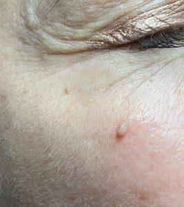 Skin Tag or Filiform Wart Removal Clinics in Colchester & Chelmsford