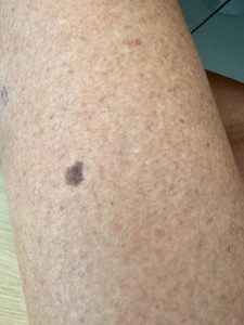 Malignant Melanoma Colchester & Chelmsford