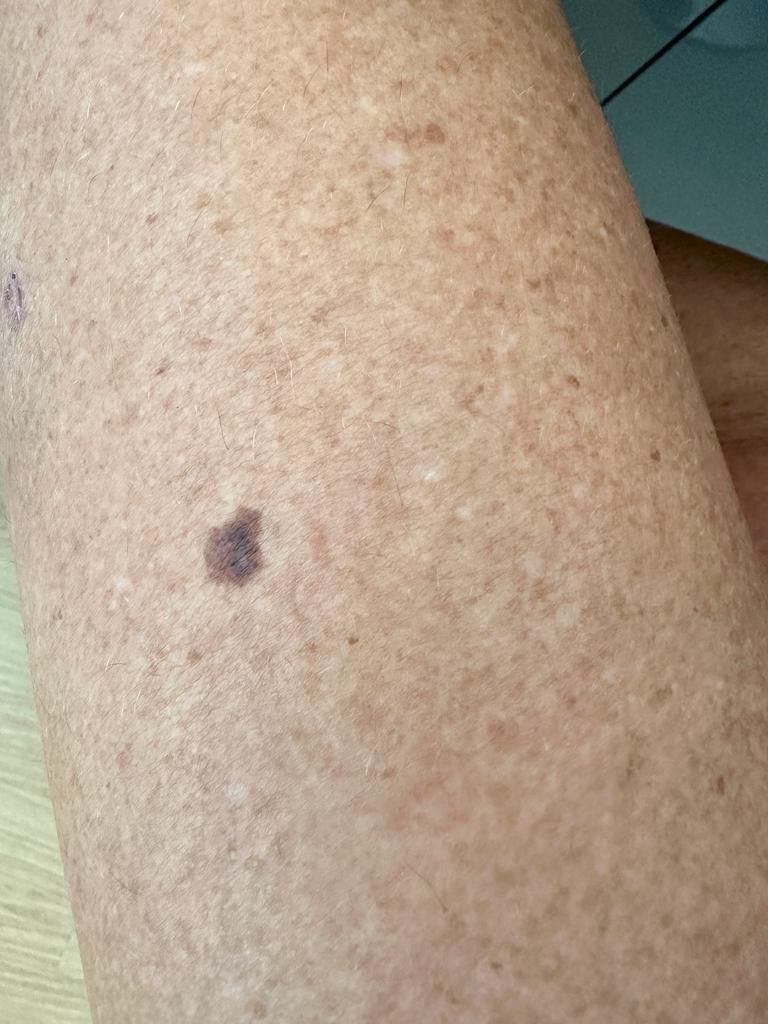 Malignant Melanoma Colchester & Chelmsford