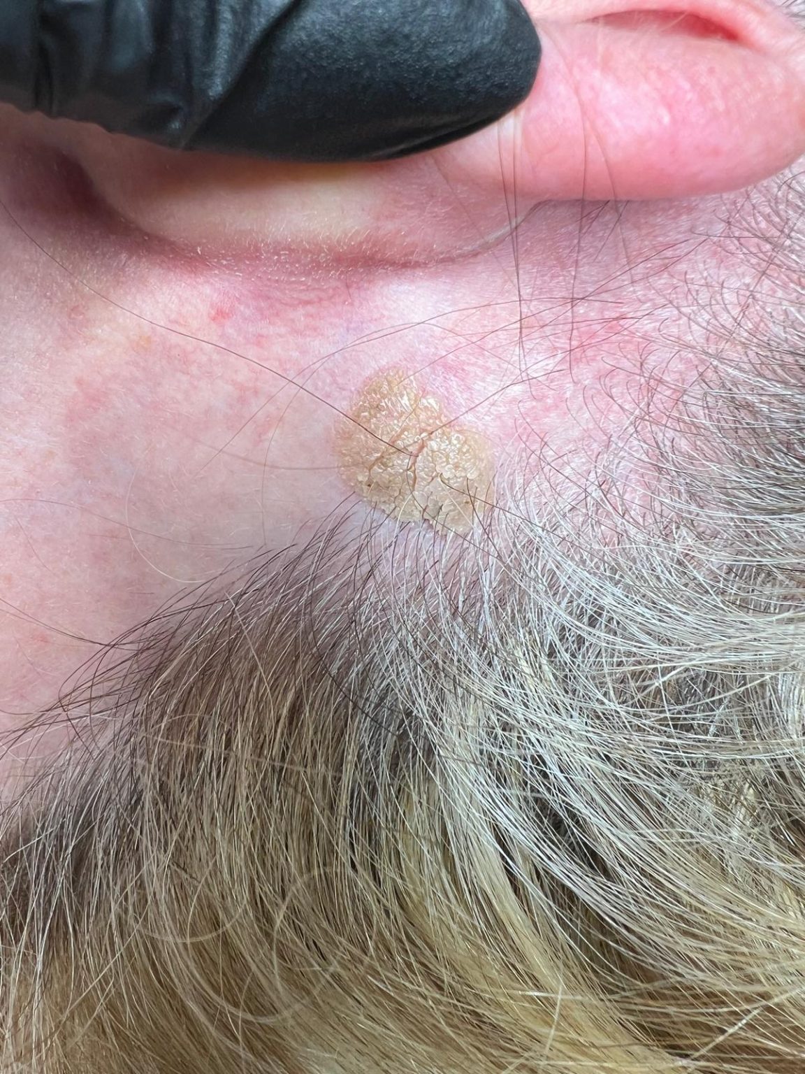 Seborrheic Keratosis Removal