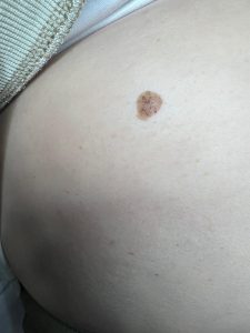 Seborrheic Keratosis Colchester & Chelmsford