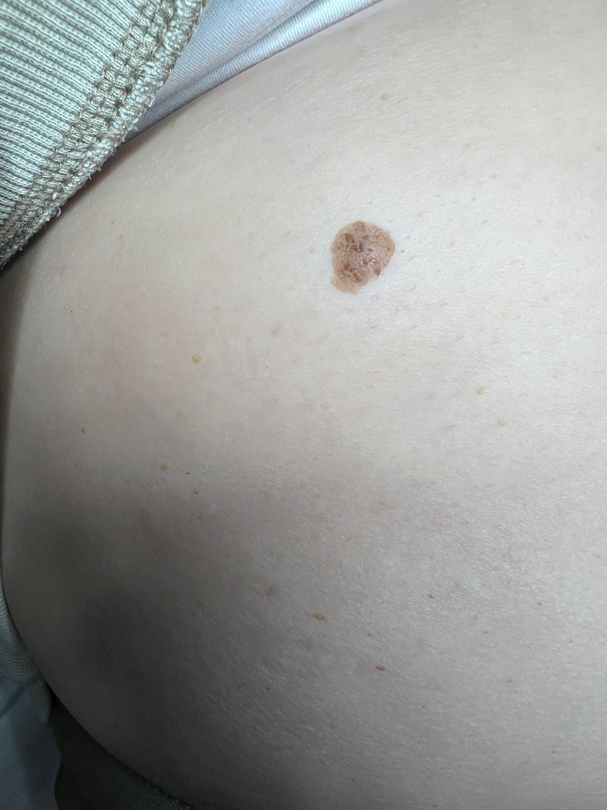 Seborrheic Keratosis Colchester & Chelmsford