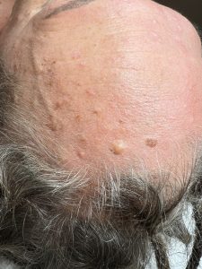 Seborrheic Keratosis Removal Before and After Colchester & Chelmsford