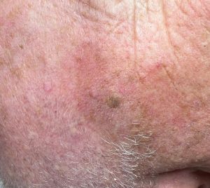 Seborrheic Keratosis on the face removal. Colchester and Chelmsford Clinics.