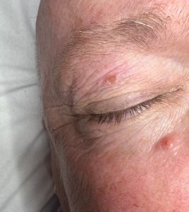 Seborrheic Keratosis on the face removal. Colchester and Chelmsford Clinics.
