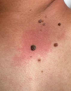 Mole Removal Colchester & Chelmsford Clinics