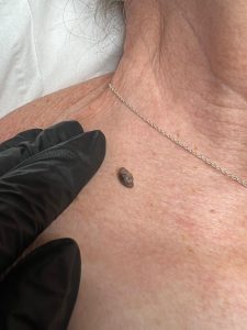 Wart Removal Before & After