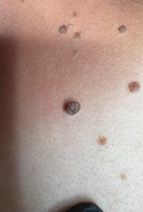 Mole Removal Colchester & Chelmsford Clinics