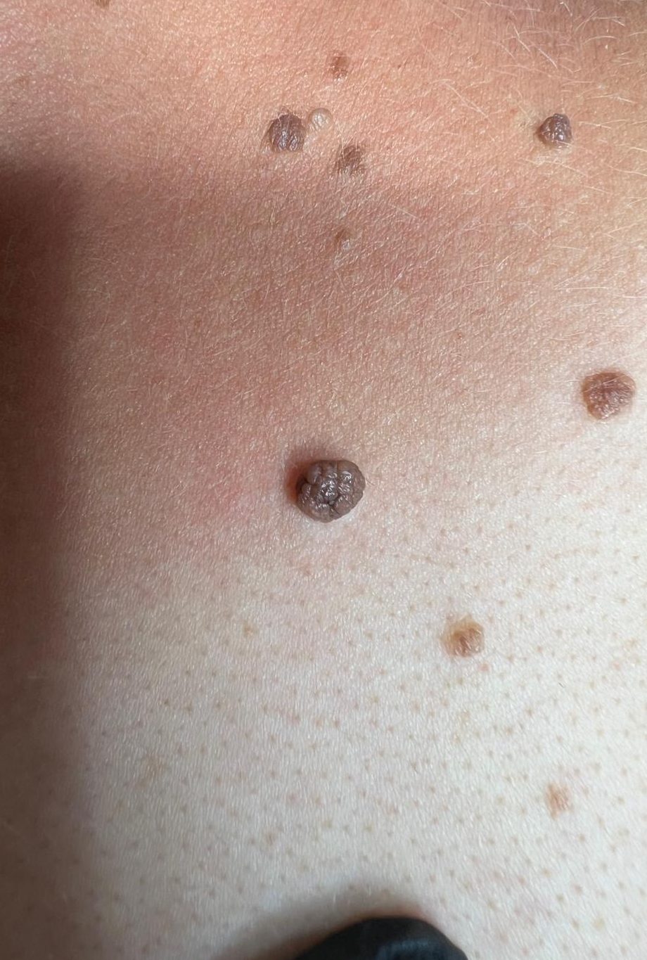 Mole Removal Colchester & Chelmsford Clinics